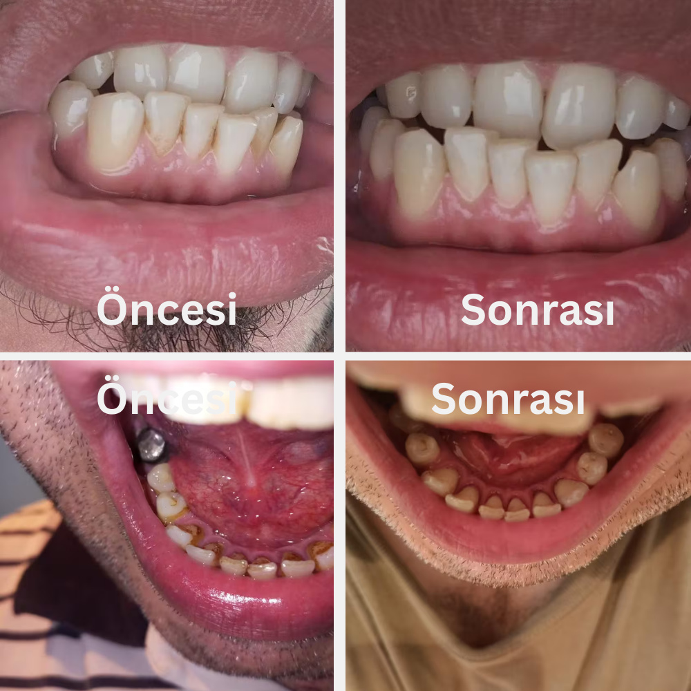 Ultrasonik Diş Temizleyici | Evde Kolay ve Güvenli Diş Taşı ve Leke Temizliği