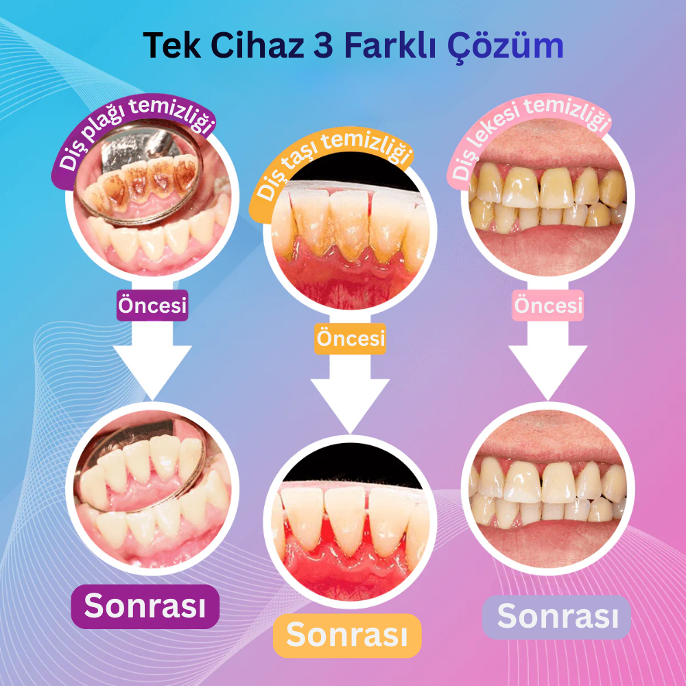 Ultrasonik Diş Temizleyici |  Evde Kolay ve Güvenli Diş Taşı ve Leke Temizliği