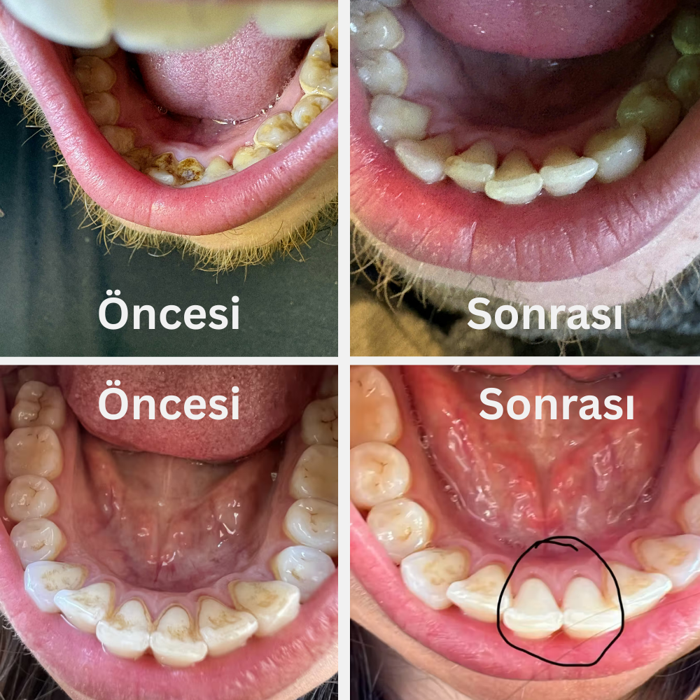 Ultrasonik Diş Temizleyici |  Evde Kolay ve Güvenli Diş Taşı ve Leke Temizliği