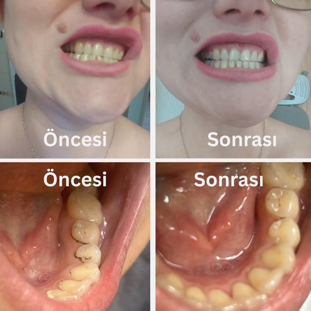 Ultrasonik Diş Temizleyici |  Evde Kolay ve Güvenli Diş Taşı ve Leke Temizliği
